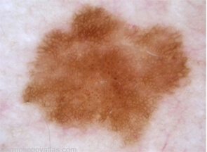 Image dermatoscopique