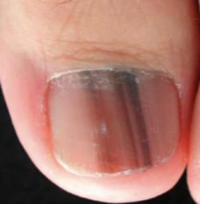 Mélanome de l'ongle débutant