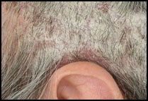 psoriasis cheveux