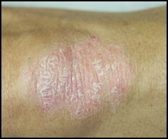 psoriasis des coudes