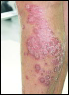 psoriasis ds jambes