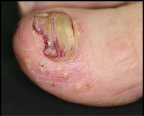 psoriasis pustuleux